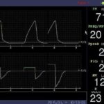 Ventilator AM- PA-700B (Standard model)